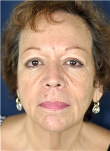 Facelift Before Photo by Michael Frederick, MD; Fort Lauderdale, FL - Case 39830