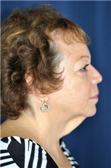 Facelift Before Photo by Michael Frederick, MD; Fort Lauderdale, FL - Case 39830
