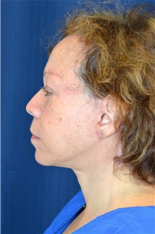 Facelift After Photo by Michael Frederick, MD; Fort Lauderdale, FL - Case 39830