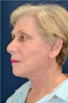 Facelift After Photo by Michael Frederick, MD; Fort Lauderdale, FL - Case 39836