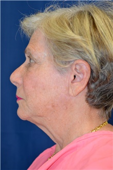 Facelift Before Photo by Michael Frederick, MD; Fort Lauderdale, FL - Case 39836