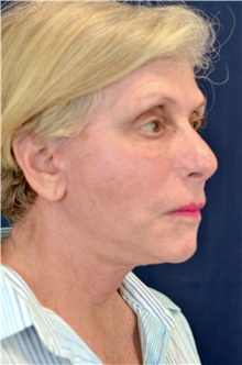 Facelift After Photo by Michael Frederick, MD; Fort Lauderdale, FL - Case 39836