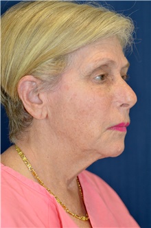 Facelift Before Photo by Michael Frederick, MD; Fort Lauderdale, FL - Case 39836