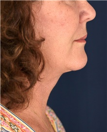 Facelift After Photo by Michael Frederick, MD; Fort Lauderdale, FL - Case 39841