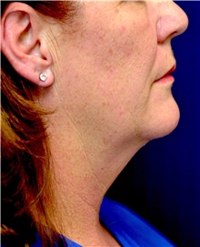 Facelift Before Photo by Michael Frederick, MD; Fort Lauderdale, FL - Case 39841