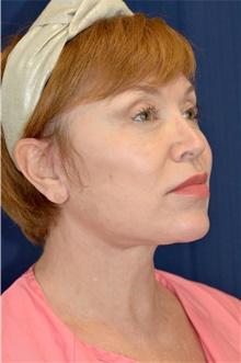Facelift After Photo by Michael Frederick, MD; Fort Lauderdale, FL - Case 39872