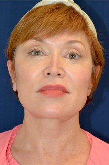 Facelift After Photo by Michael Frederick, MD; Fort Lauderdale, FL - Case 39872