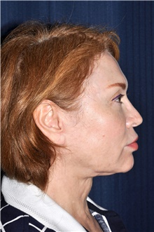 Facelift Before Photo by Michael Frederick, MD; Fort Lauderdale, FL - Case 39872