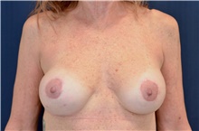 Breast Implant Revision After Photo by Michael Frederick, MD; Fort Lauderdale, FL - Case 39873