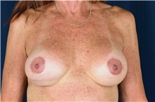 Breast Implant Revision Before Photo by Michael Frederick, MD; Fort Lauderdale, FL - Case 39873