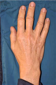Hand Surgery After Photo by Michael Frederick, MD; Fort Lauderdale, FL - Case 39874