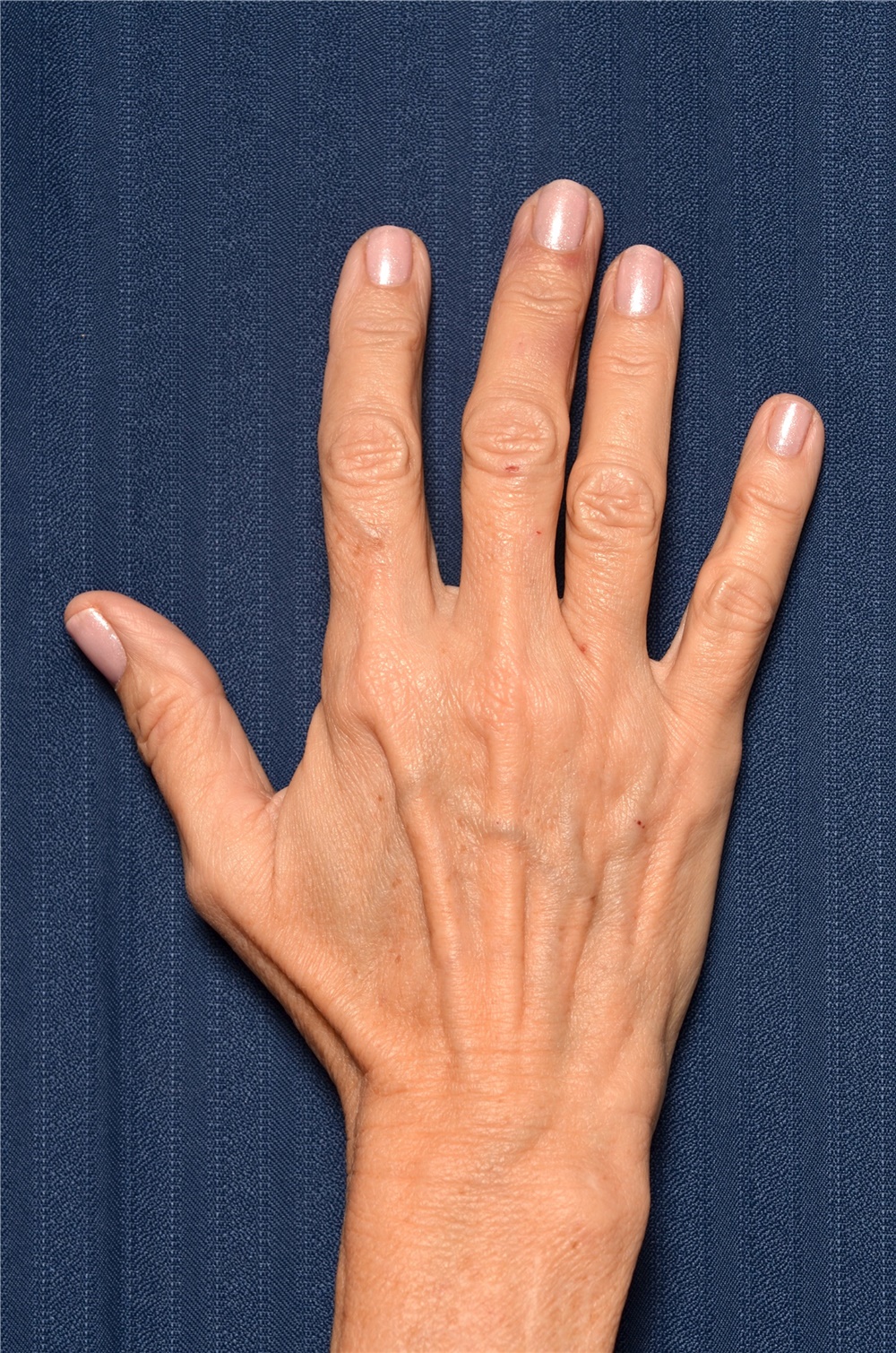 What is Involved in Hand Reconstruction Surgery?