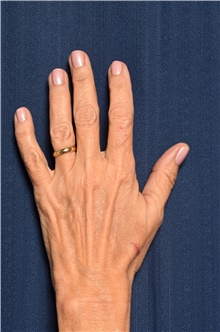 Hand Surgery Before Photo by Michael Frederick, MD; Fort Lauderdale, FL - Case 39874