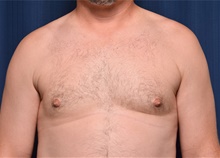 Male Breast Reduction After Photo by Michael Frederick, MD; Fort Lauderdale, FL - Case 39875