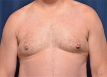 Male Breast Reduction Before Photo by Michael Frederick, MD; Fort Lauderdale, FL - Case 39875