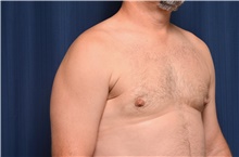 Male Breast Reduction After Photo by Michael Frederick, MD; Fort Lauderdale, FL - Case 39875