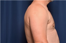 Male Breast Reduction After Photo by Michael Frederick, MD; Fort Lauderdale, FL - Case 39875