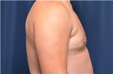 Male Breast Reduction Before Photo by Michael Frederick, MD; Fort Lauderdale, FL - Case 39875