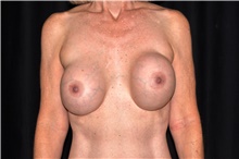 Breast Implant Revision Before Photo by Michael Frederick, MD; Fort Lauderdale, FL - Case 39876