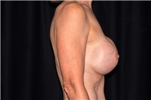Breast Implant Revision Before Photo by Michael Frederick, MD; Fort Lauderdale, FL - Case 39876