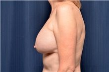 Breast Implant Revision Before Photo by Michael Frederick, MD; Fort Lauderdale, FL - Case 39878