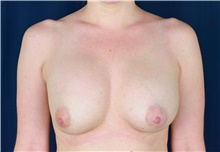 Breast Implant Revision Before Photo by Michael Frederick, MD; Fort Lauderdale, FL - Case 39880
