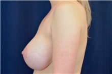 Breast Implant Revision After Photo by Michael Frederick, MD; Fort Lauderdale, FL - Case 39880