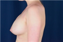 Breast Implant Revision Before Photo by Michael Frederick, MD; Fort Lauderdale, FL - Case 39880