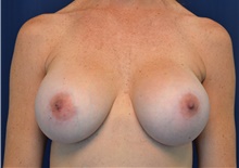 Breast Implant Revision After Photo by Michael Frederick, MD; Fort Lauderdale, FL - Case 39881