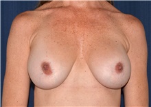 Breast Implant Revision Before Photo by Michael Frederick, MD; Fort Lauderdale, FL - Case 39881