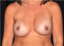 Breast Implant Revision Before Photo by Michael Frederick, MD; Fort Lauderdale, FL - Case 39883