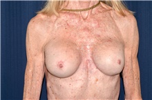 Breast Implant Revision After Photo by Michael Frederick, MD; Fort Lauderdale, FL - Case 39884