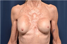 Breast Implant Revision Before Photo by Michael Frederick, MD; Fort Lauderdale, FL - Case 39884