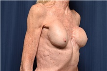 Breast Implant Revision Before Photo by Michael Frederick, MD; Fort Lauderdale, FL - Case 39884