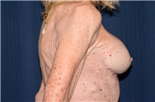 Breast Implant Revision After Photo by Michael Frederick, MD; Fort Lauderdale, FL - Case 39884