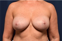Breast Implant Revision After Photo by Michael Frederick, MD; Fort Lauderdale, FL - Case 39886