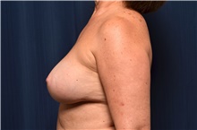 Breast Implant Revision After Photo by Michael Frederick, MD; Fort Lauderdale, FL - Case 39886