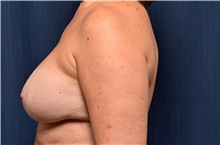 Breast Implant Revision Before Photo by Michael Frederick, MD; Fort Lauderdale, FL - Case 39886