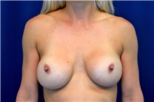Breast Implant Revision Before Photo by Michael Frederick, MD; Fort Lauderdale, FL - Case 39890