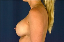 Breast Implant Revision After Photo by Michael Frederick, MD; Fort Lauderdale, FL - Case 39890