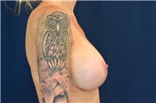 Breast Implant Revision After Photo by Michael Frederick, MD; Fort Lauderdale, FL - Case 39892