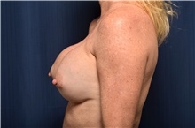 Breast Implant Revision Before Photo by Michael Frederick, MD; Fort Lauderdale, FL - Case 39895