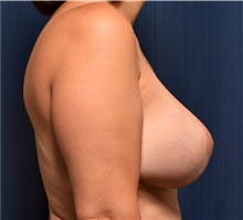 Breast Implant Revision After Photo by Michael Frederick, MD; Fort Lauderdale, FL - Case 39896