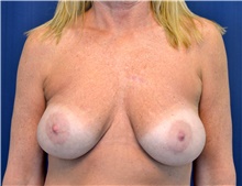 Breast Implant Revision Before Photo by Michael Frederick, MD; Fort Lauderdale, FL - Case 39897