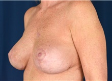 Breast Implant Revision After Photo by Michael Frederick, MD; Fort Lauderdale, FL - Case 39897