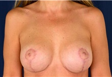 Breast Implant Revision After Photo by Michael Frederick, MD; Fort Lauderdale, FL - Case 39898