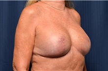 Breast Implant Revision After Photo by Michael Frederick, MD; Fort Lauderdale, FL - Case 39900