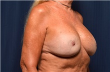 Breast Implant Revision Before Photo by Michael Frederick, MD; Fort Lauderdale, FL - Case 39900