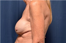 Breast Implant Revision Before Photo by Michael Frederick, MD; Fort Lauderdale, FL - Case 39901