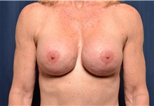 Breast Implant Revision After Photo by Michael Frederick, MD; Fort Lauderdale, FL - Case 39903